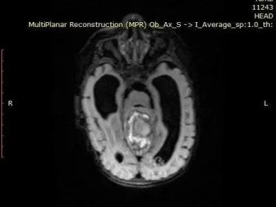 В Башкирии врачи удалили опухоль мозга двухмесячному малышу