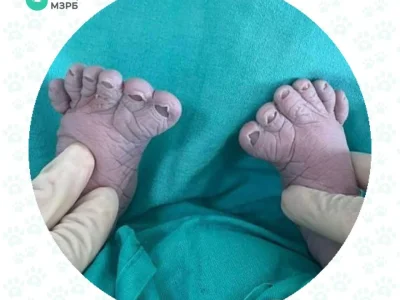 В Башкирии родился ребенок с 6-ю пальцами на ноге