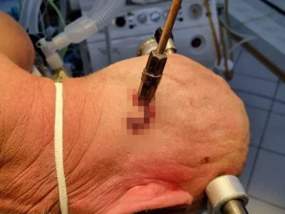 В Башкирии врачи вытащили отвертку из головы 44-летнего мужчины